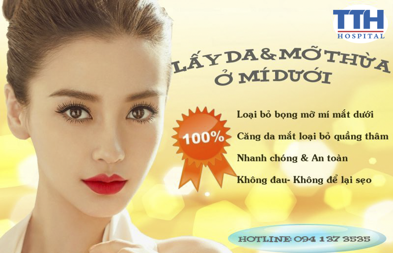 Lấy mỡ, da thừa mí mắt